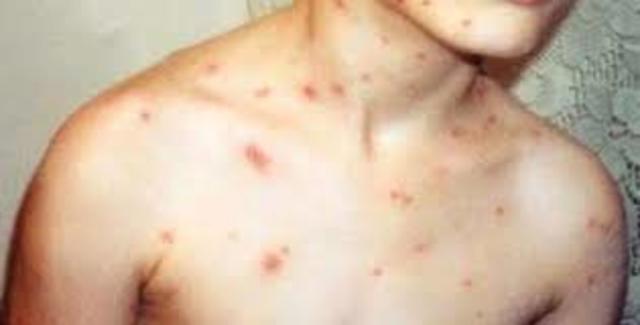 La Asamblea Mundial de la Salud inicia el programa de erradicación de la viruela.