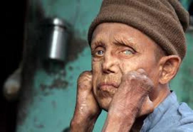 La Asamblea Mundial de la Salud adopta una resolución para eliminar la lepra.