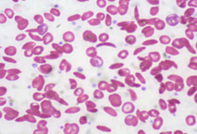 Sickle Cell Disease named