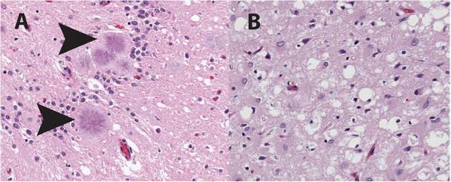 Spongiform encephalopathy