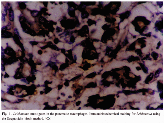 Visceral leishmaniasis