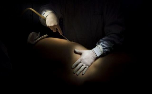 Otra mujer murió durante cirugía estética en Medellín