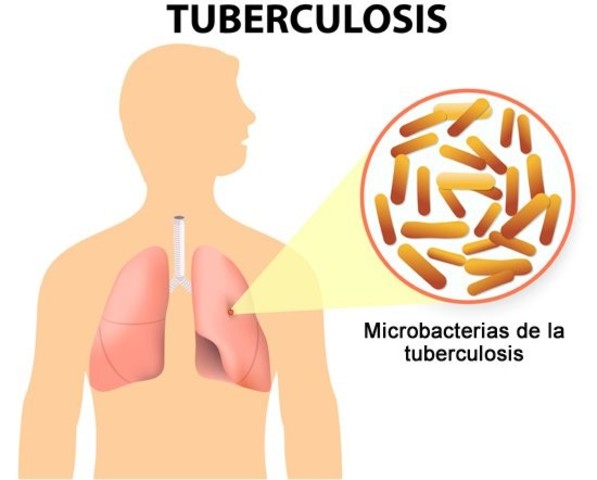 CONTRAJO TUBERCULOSIS