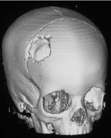 Herida de mi cráneo