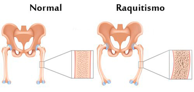 Edward Mellanby descubre la vitamina D y muestra que su ausencia provoca raquitismo (deformación de los huesos)