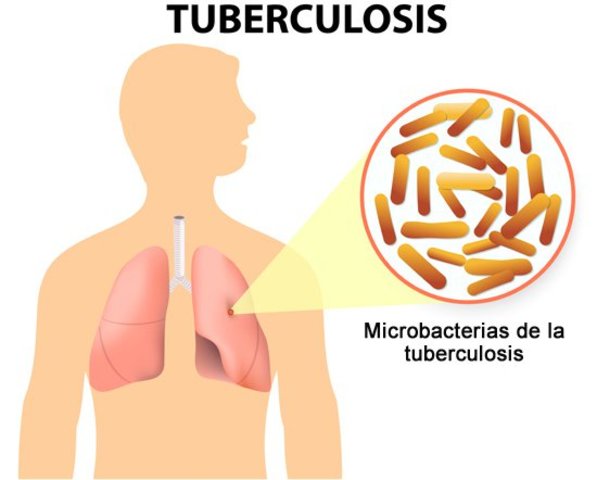 Primera vacuna para la tuberculosis.