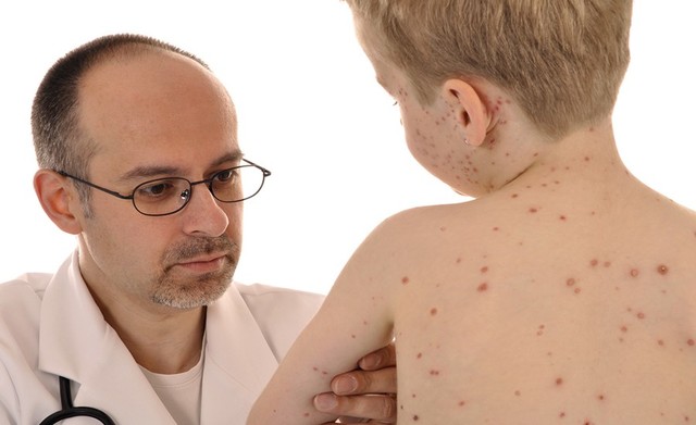 Primera vacuna para el sarampión.