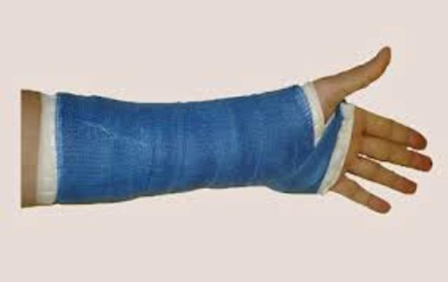 I broke my arm from Track.