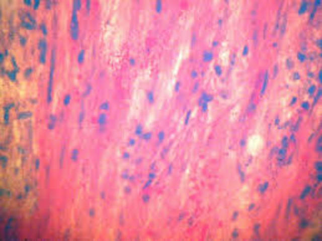 Se desarrollan tratamientos para la lepra