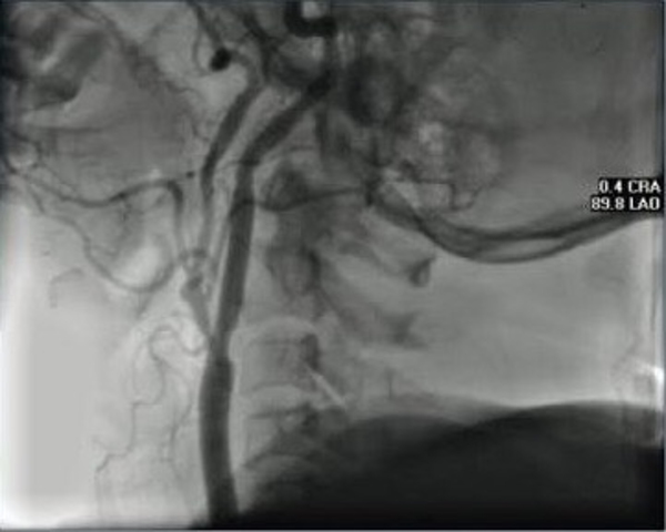 Primer aneurisma de la arteria basilar cerebral curado