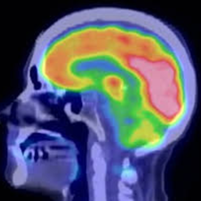 Timeline: Nuclear Medicine- Cancer Treatment