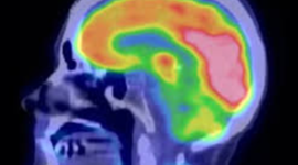 Timeline: Nuclear Medicine- Cancer Treatment