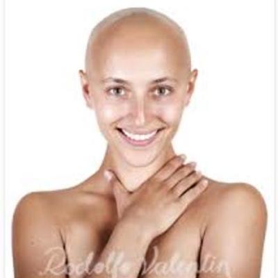 Timeline: Alopecia timeline