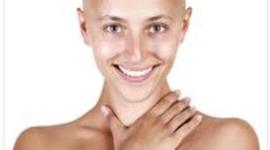 Timeline: Alopecia timeline