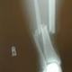 Tib fib fracture