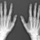 Bone xray hands