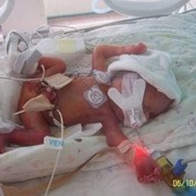 Timeline:  PARTO PREMATURO. CAUSAS, PREVENCIÓN Y MANEJO.