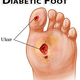Foot ulcers