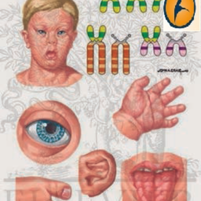 Timeline: linea de tiempo caso clínico mucopolisacaridosis tipo I