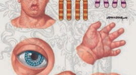 Timeline: linea de tiempo caso clínico mucopolisacaridosis tipo I