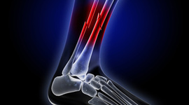 Timeline: Historia de la Osteosintesis