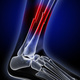 Original fractura tibia perone
