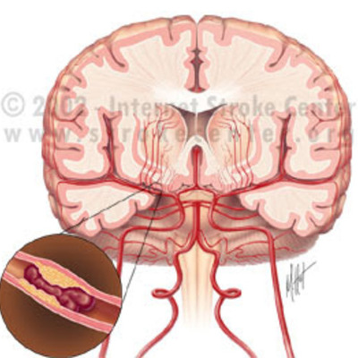 Timeline: Fisiopatologia de EVC