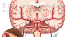 Timeline: Fisiopatologia de EVC
