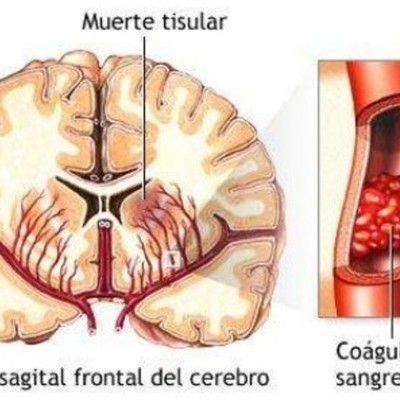 Timeline: Fisiopatología EVC