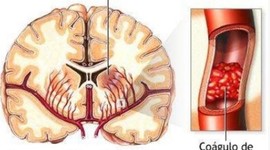 Timeline: Fisiopatología EVC