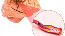 Timeline: Fisiopatología del EVC