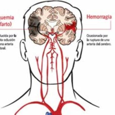 Timeline: Fisopatología del EVC