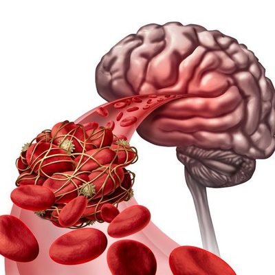 Timeline: Fisiopatología del evento vascular cebral (EVC)