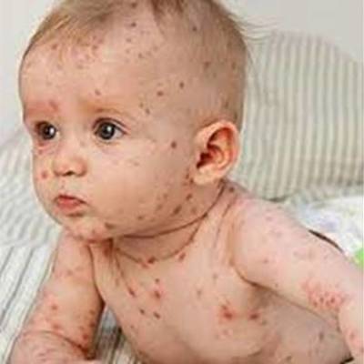 Timeline: Vacuna viruela