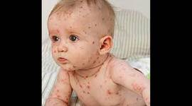 Timeline: Vacuna viruela