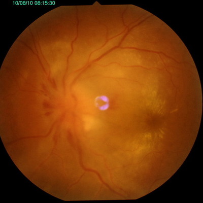 Timeline: INSTRUMENTOS DE EXPLORACIÓN OFTALMOLOGICA