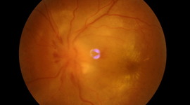 Timeline: INSTRUMENTOS DE EXPLORACIÓN OFTALMOLOGICA