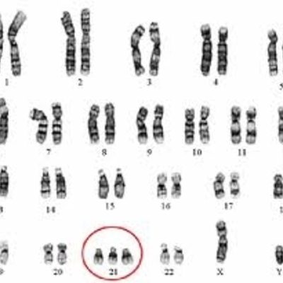 Timeline: sindrome por alteracion de ADN