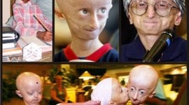 Timeline: Sindromes Por Alteraciones Cromosómicas