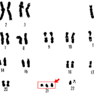 Timeline: Síndrome por alteración de ADN