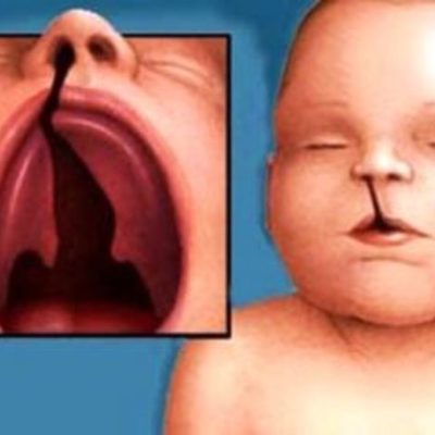 Timeline: Sindrome de patau