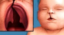 Timeline: Sindrome de patau