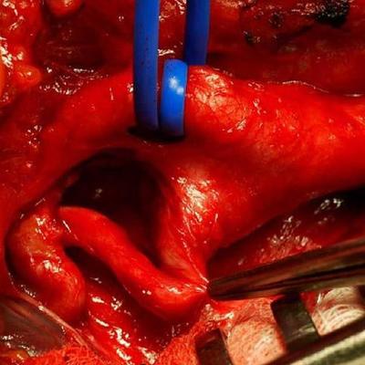 Timeline: ENDARTERECTOMIA