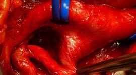 Timeline: ENDARTERECTOMIA