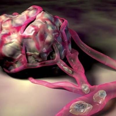 Timeline: Metastatic Cancer Timline