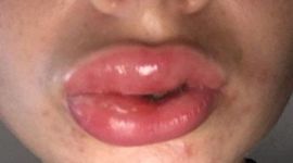 Timeline: Immune System Timeline