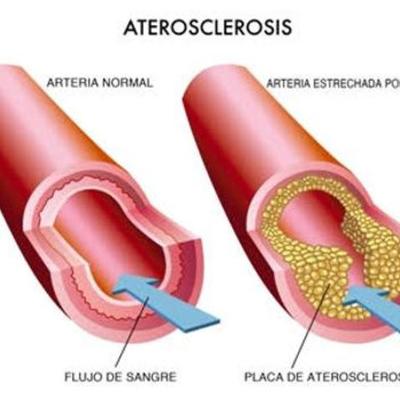 Timeline: Ateroesclerosis