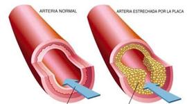 Timeline: Ateroesclerosis