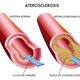 Ateroesclerosis