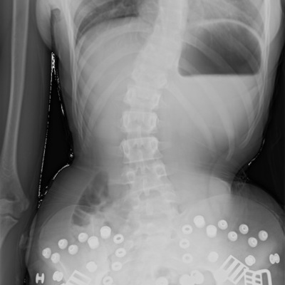 Timeline: Brianna's Spine timeline